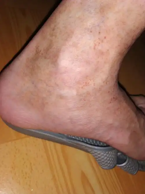 脚上很多红色血点,脚很黑,这2种是什么病,大虾来?