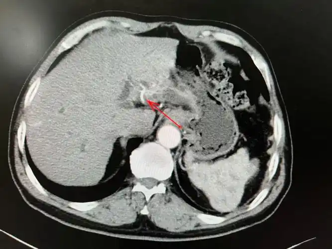 复发性肝内胆管结石伴早期胆管癌左半肝切除一例_肝内胆管结石_肝内