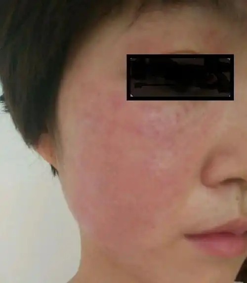 春来又现桃花癣千万注意化妆品也会引起面部皮炎