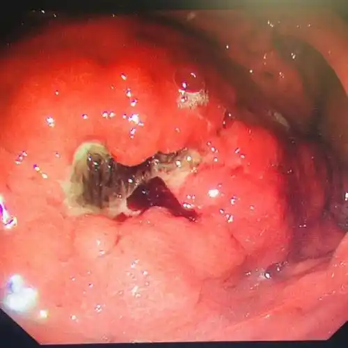 知名演员罹患胃癌去世,专家:这个信号一定要警惕!_螺旋杆菌