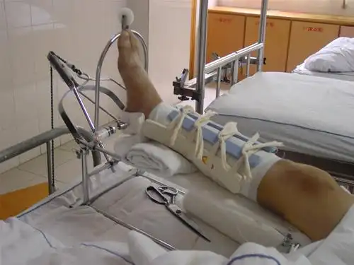 骨折 医药费 一般大腿干骨骨折的治疗费用大概多少钱?