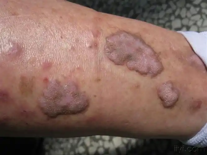 肥厚性扁平苔藓 - 皮肤及性传播疾病讨论版 - 爱爱医医学论坛