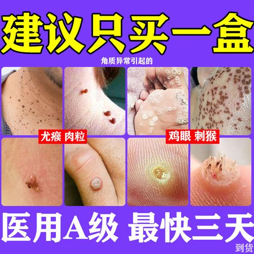 瘊子疣体脱落皮肤用药维a酸乳膏 一盒【几粒小疣】建议买多盒疗程治疗