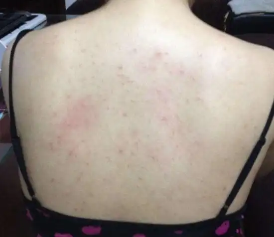 后背上长痘痘怎么消除(胸前后背长痤疮的原因_大全-幸福起航