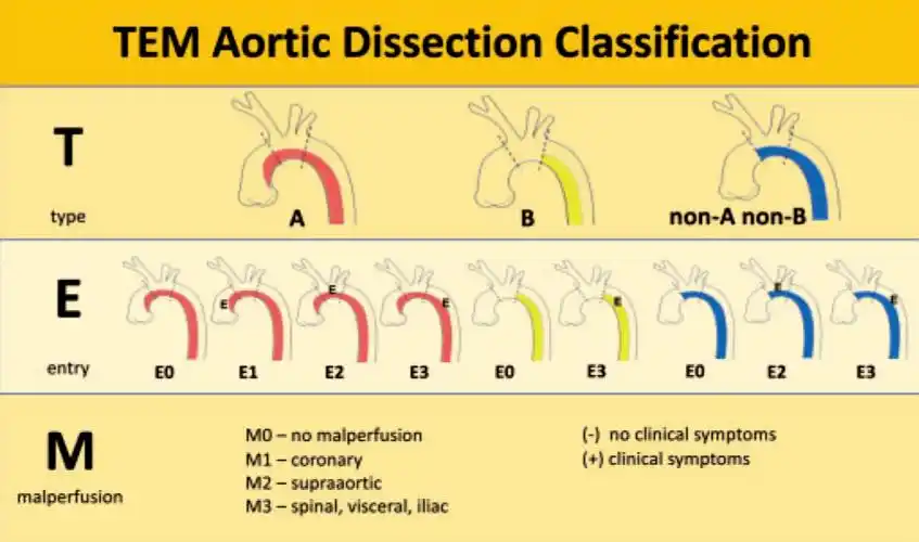 最新主动脉夹层分型方法——tem分型详解