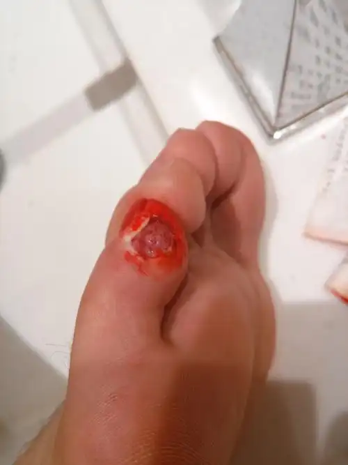 脚上长了个鸡眼,用了鸡眼膏,现在挖成这样算去除鸡眼了嘛?