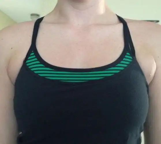 什么类型的副乳需要开刀切除?