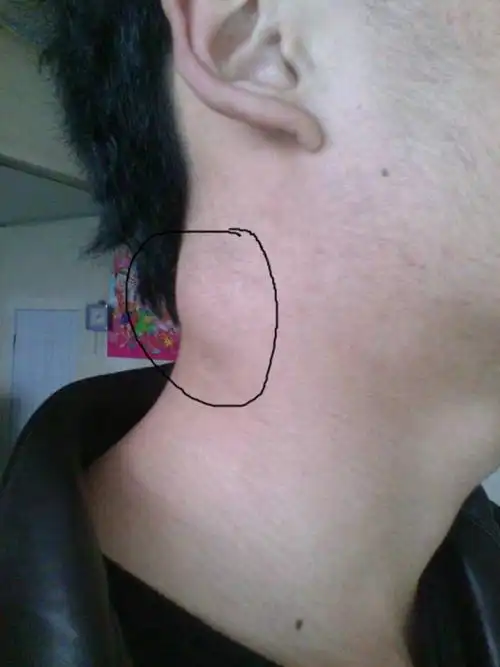 发热伴颈部肿块,警惕间变大细胞淋巴瘤