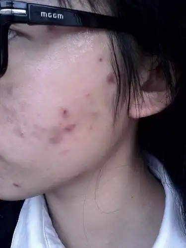 本人17岁,如图所示脸总是张类似脂肪粒的痘痘,总爱扣,现在怎么办,会留