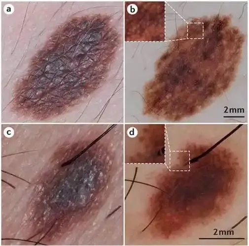 黑色素瘤的诊断与治疗进展