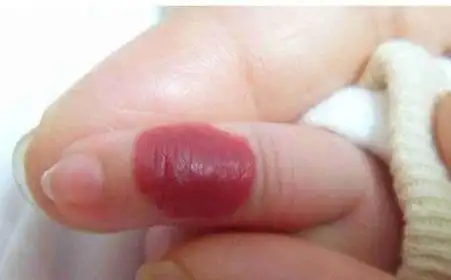 阴囊血管瘤有影响吗