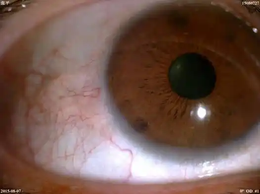 睑裂斑需要手术治疗吗