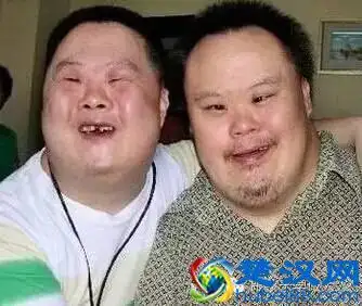 患此症的孩子俗称痴呆儿.