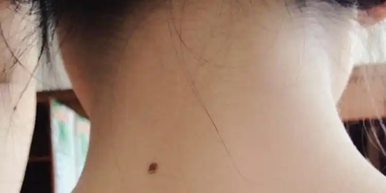 脖子上长痣是不是不好啊? 我的脖子前面正中间长了个痣