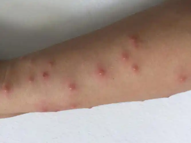 皮疹多发生于躯干,四肢伸侧.