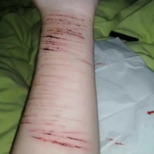 中国红十字心理咨询小知识:女我一个月前检查出中度