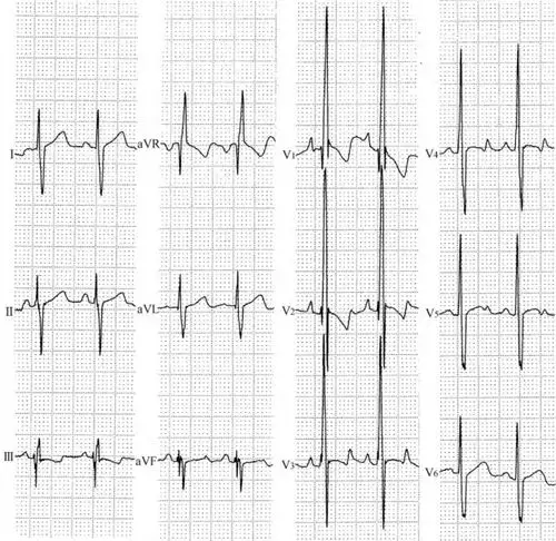 先天性心脏病房间隔缺损尖角波结构性心脏病心电