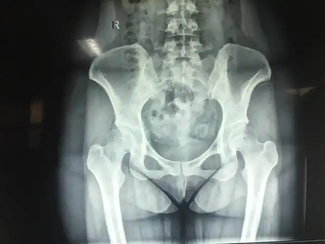其它 髋关节镜微创手术治疗股骨髋臼撞击症术前骨盆正位x光片提示左侧