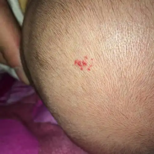 宝宝现在快3个月了,可他头上的红点也在慢慢扩散,求指点.