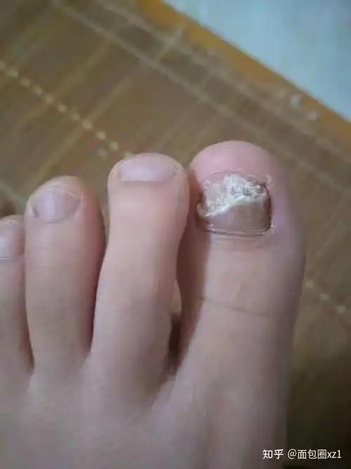 灰指甲早期症状是什么样子的可以治好吗