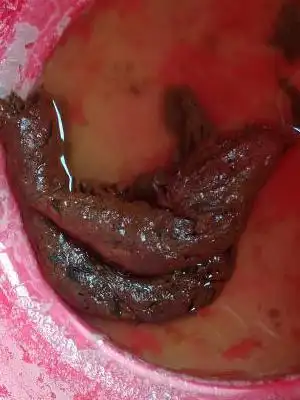 肚子不疼,一天两三次不成形大便,吃黄连素好一点,不吃就复发,现在吃