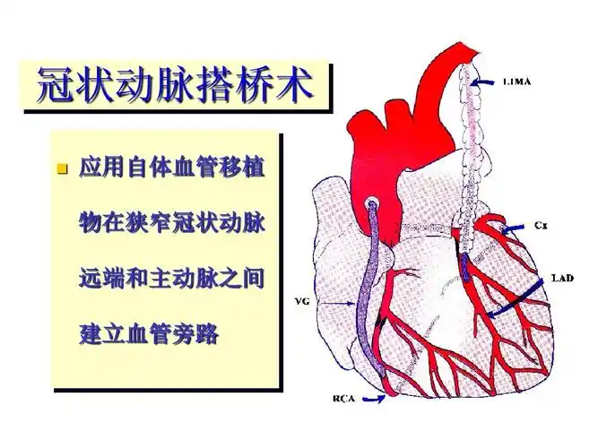 分类 医药卫生 基础医学 冠心病外科现状及手术ppt 冠状动脉搭桥术
