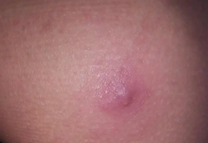 谁能告诉我这是什么?是一个硬硬的.一碰就疼的一个包.是毛囊炎吗?