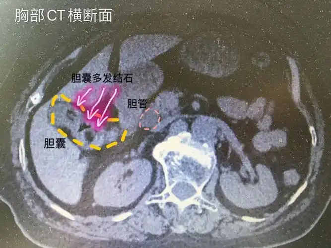 胆结石,ct和mri区别大