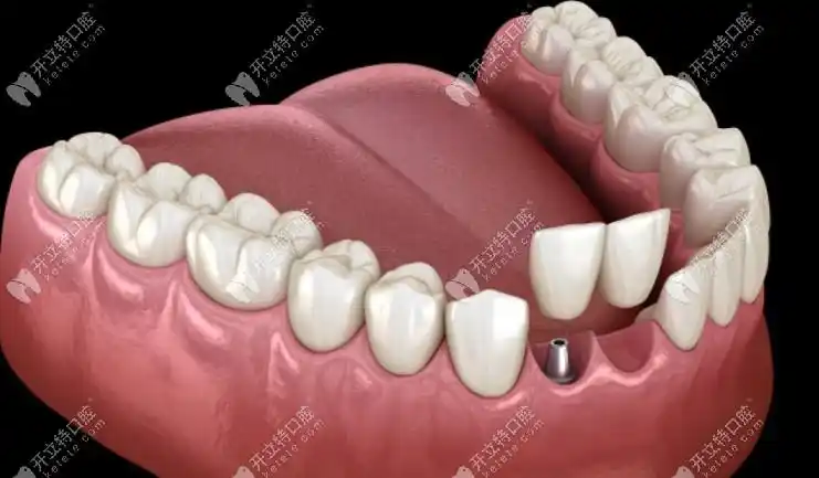 韩国奥齿泰种植体出新品啦:奥齿泰onefit abutment个性化基台上市啦!