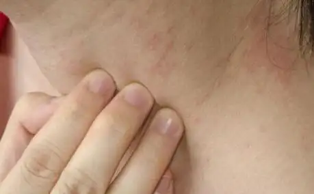 艾滋病皮疹症状知道得更有用