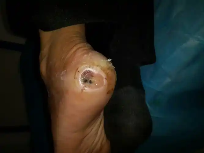 截肢吗,怎么确诊怎么治我父亲的左脚跟长了约直径3公分大小凸起的硬痣