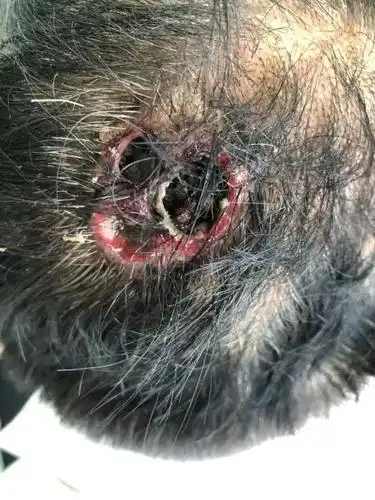 慎点福建一老汉感染蝇蛆病头皮下取出41条活虫