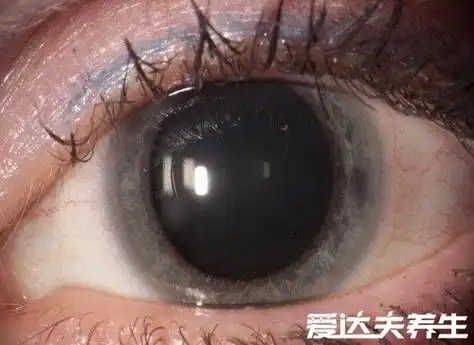 正常瞳孔和瞳孔放大图,非正常对光反应可能是青光眼