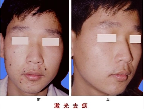 祛痣前后对比图