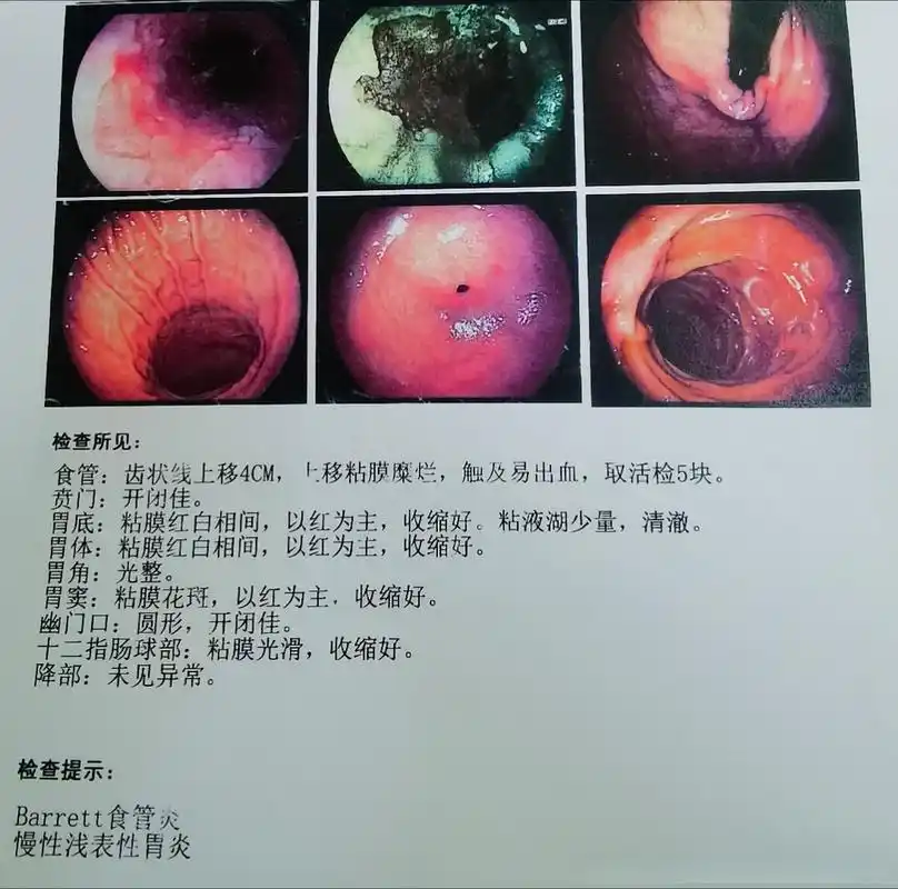 这个是今天看的一个病人,当地的胃镜呢?