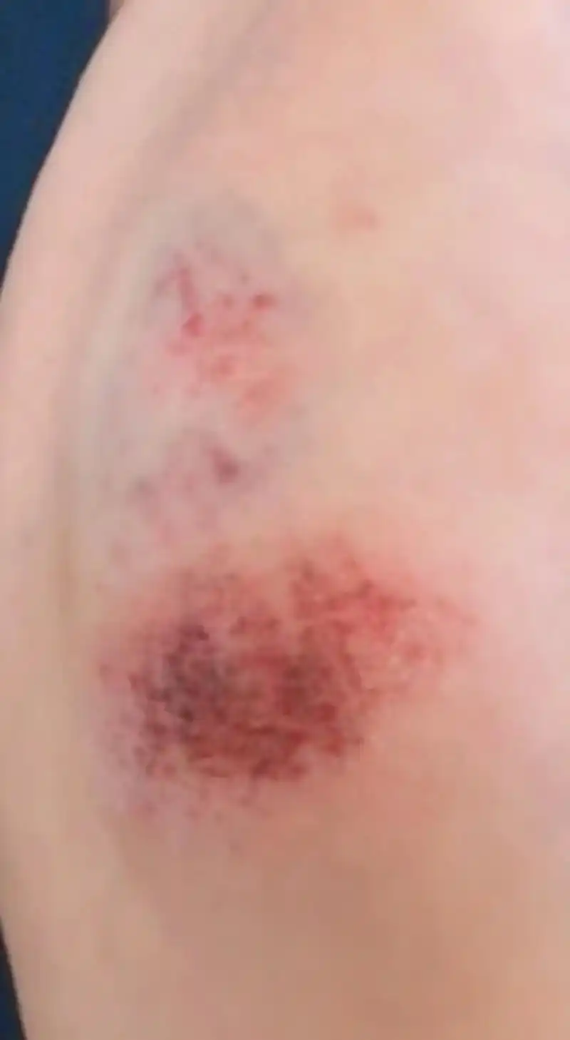 脚疼到睡不下,一不小心摔伤了腿和脚,俗话说见血破灾,但愿有个 - 抖音