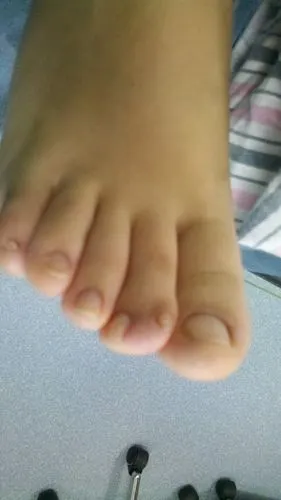 脚趾多并指畸形怎么治疗?