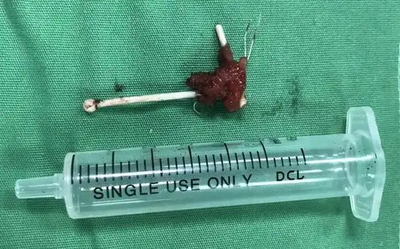 经手术取出体外的t型节育环.(图源:院方提供)