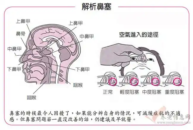 长期鼻塞需区分鼻炎与鼻咽癌的差别不可小觑