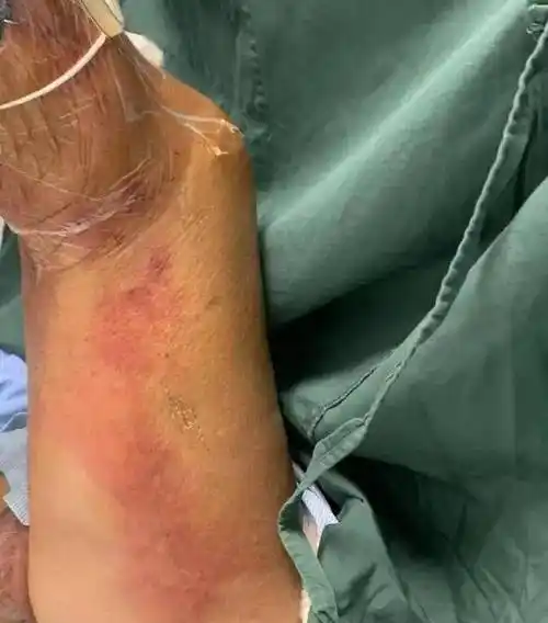 而是出现了一片红霞般的皮肤改变,并迅速向大腿根部蔓延,阴囊表皮有剥