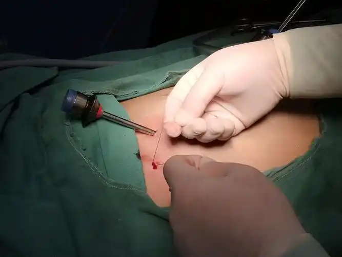 儿童疝腹腔镜下高位结扎术