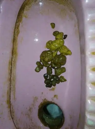 拉黑便是什么原因引起的