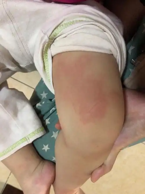 小孩长了这个红斑,好两天,又反复,医生说湿疹,又有说荨麻疹!又忌口.