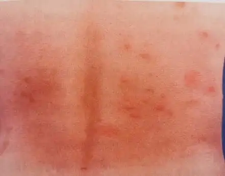 夏天到了小心这些虫