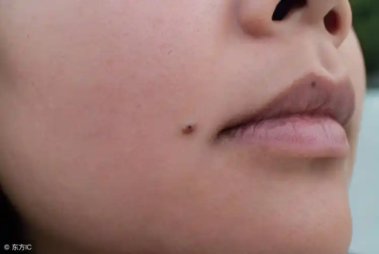 痣相解说:在嘴边的痣点掉会有什么影响!