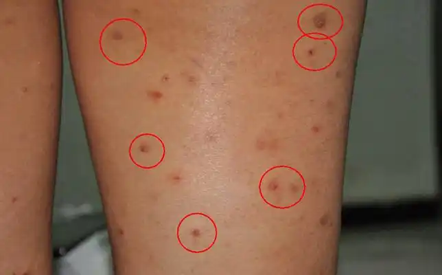 艾滋病红斑图片 (59)