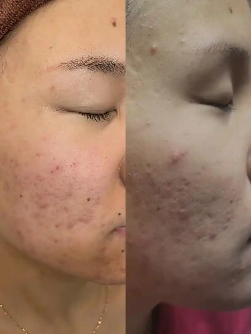 问题性皮肤管理 #痘痘 #热门 #同城美容 痘痘并不可怕, - 抖音