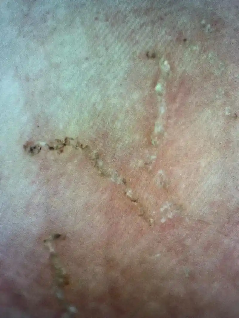 你见过在皮肤上打隧道的虫子吗