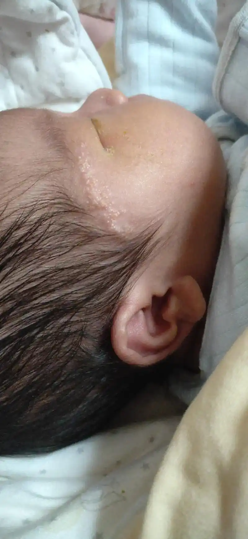 整理一下术后恢复的照片#皮脂腺痣#全麻切除