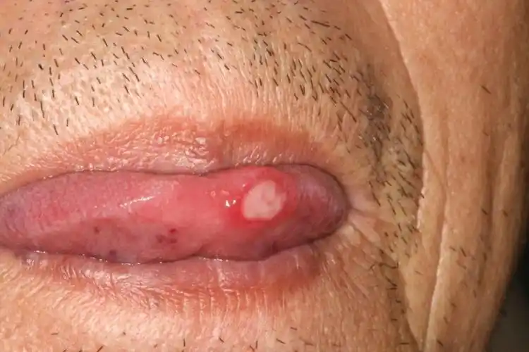 口腔溃疡在舌头上图